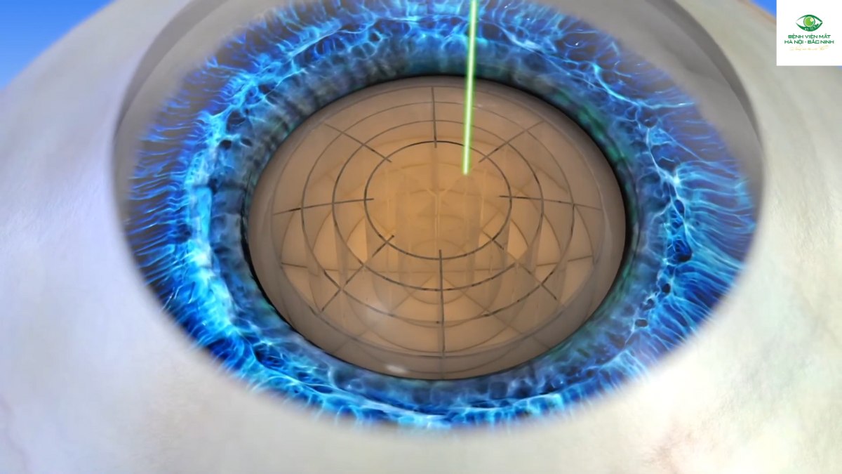 Tổng quan quy trình phẫu thuật laser cataract