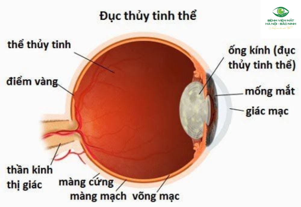 Phẫu thuật phaco đục thủy tinh thể