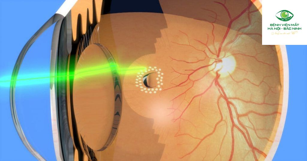 Laser Quang Đông Võng Mạc