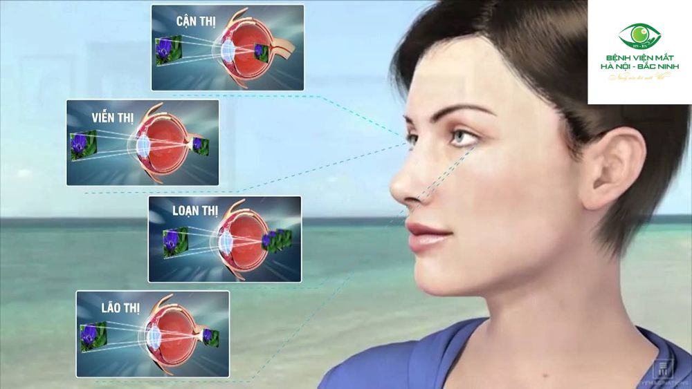 Nguyên nhân gây tật khúc xạ