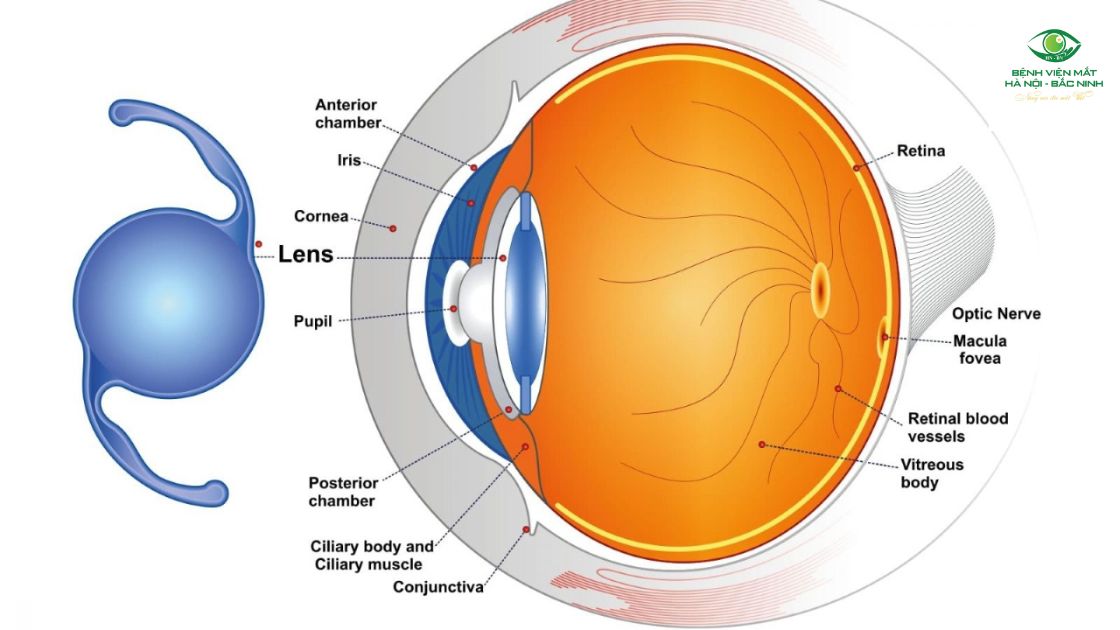 Cảm giác thị giác sau khi cấy thuỷ tinh thể đa tiêu cự cao cấp