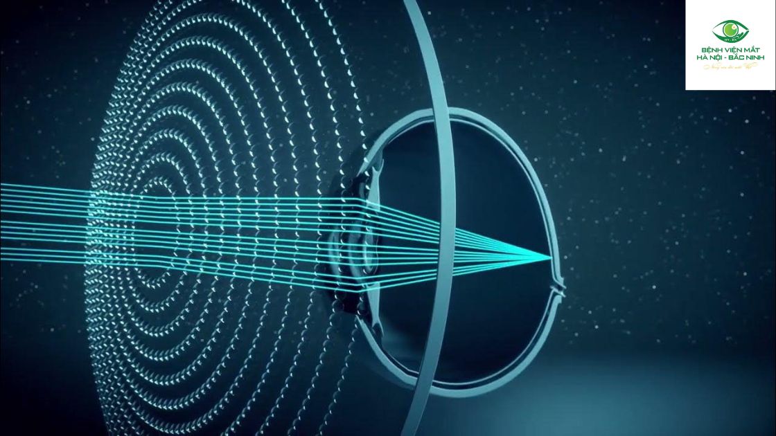 Cảm giác sử dụng và khả năng thích nghi của trẻ khi đeo tròng kính Essilor Stellest