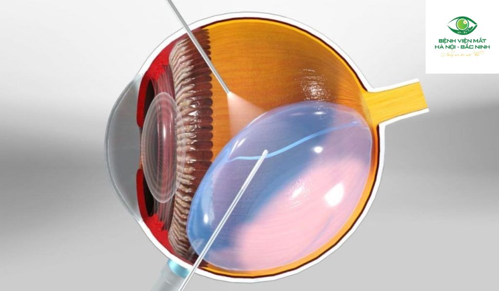 Hiệu quả điều trị và tiên lượng thị lực