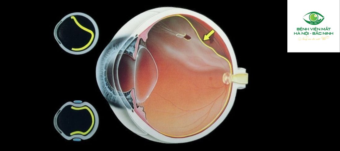 Chăm sóc và theo dõi sau phẫu thuật cắt dịch kính