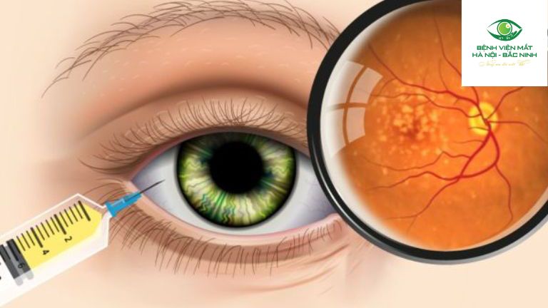 Các loại thuốc thường dùng trong tiêm nội nhãn